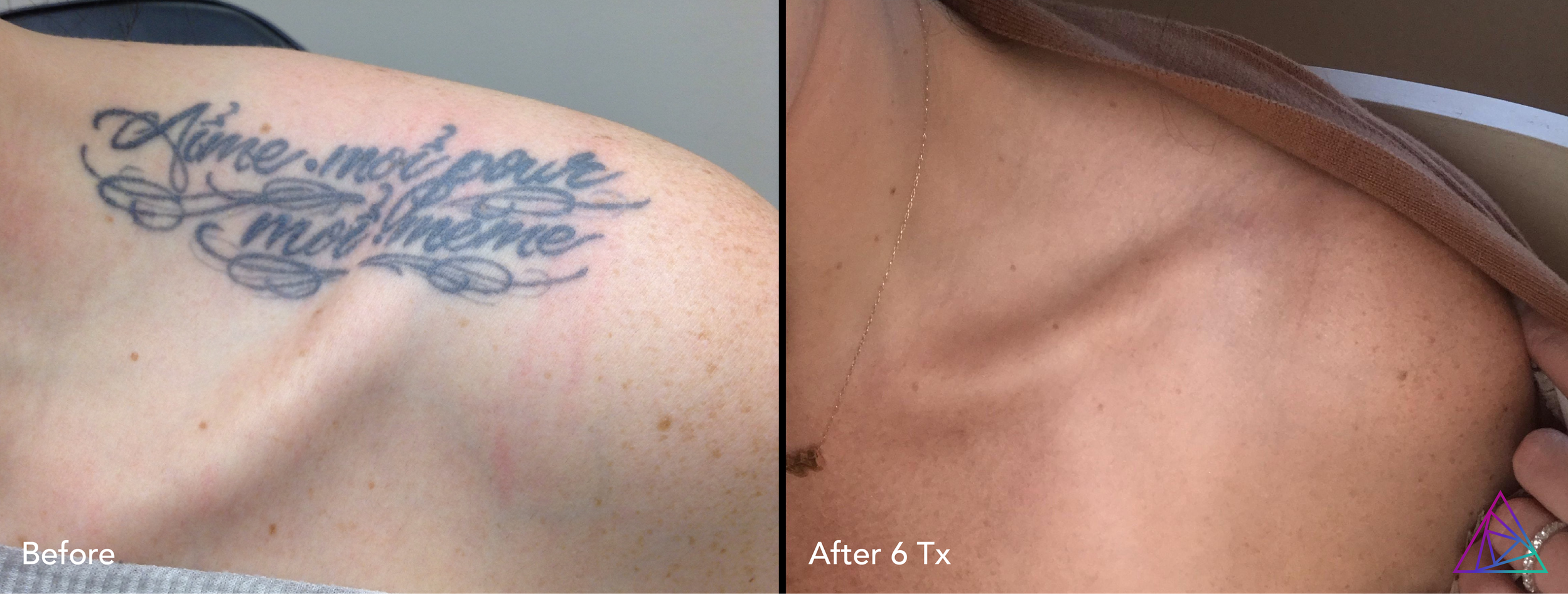 Before and after tattoo removal